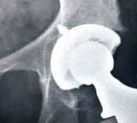 Metal-on-Metal Hip Implant Recall